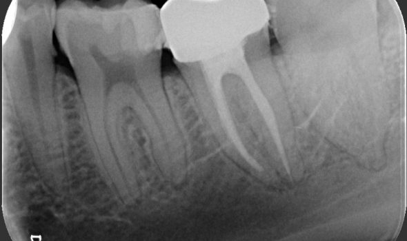 benefici-endodonzia benefici endodonzia