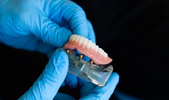 impianto-dentale impianto dentale