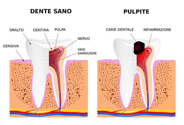 5 Falsi Miti Sulla Carie Dentale