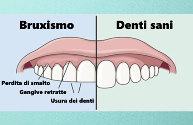 bruxismo e serramento come porvi rimedio