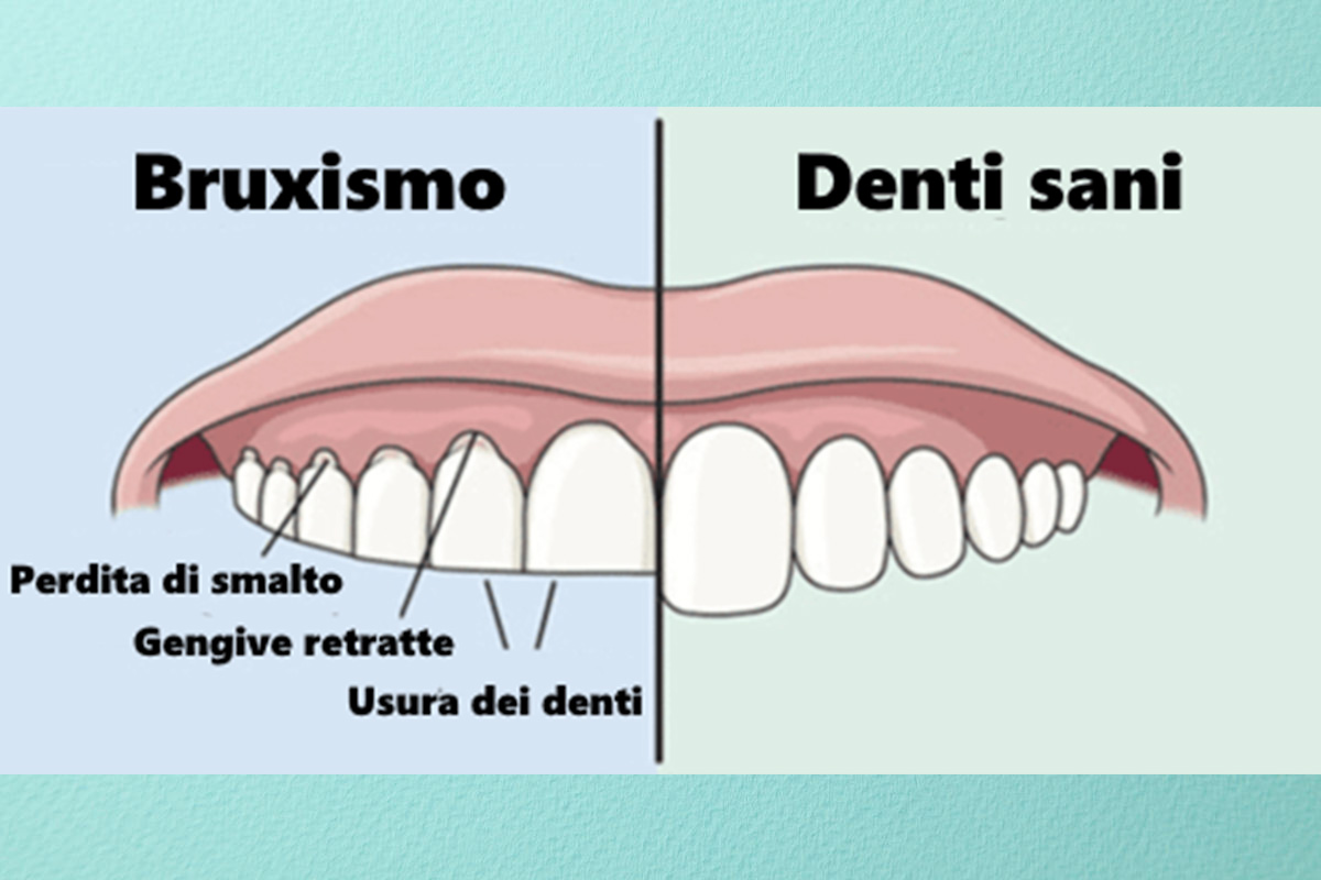 bruxismo e serramento come porvi rimedio