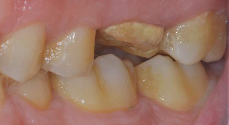 prima dell'operazioni di protesi fissa su denti