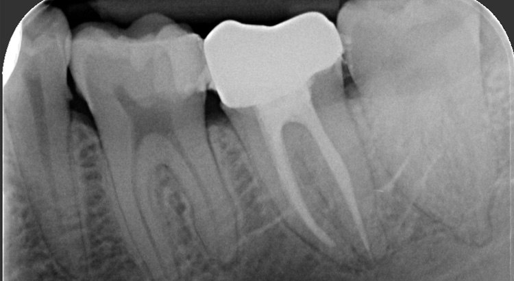 risultato post endodonzia
