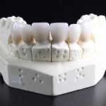 faccette dentali